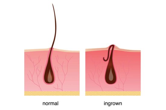 how to prevent ingrown hairs